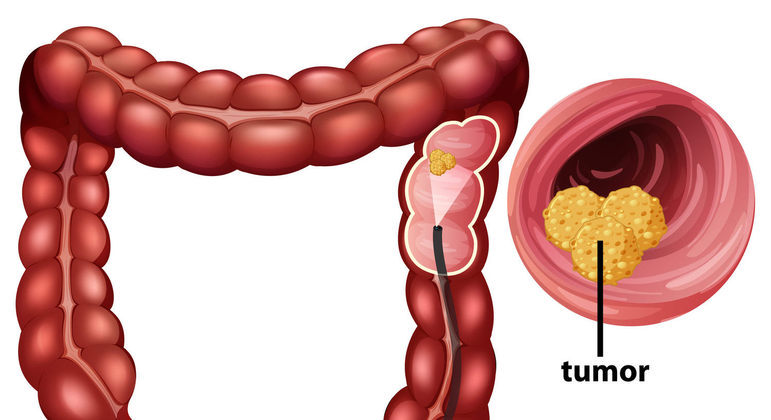 cancer-colorretal-02072022153938451