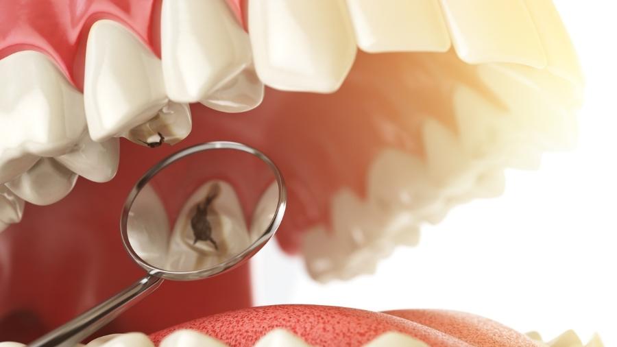 dente-com-carie-caries-boca-dentes-1663701135497_v2_900x506