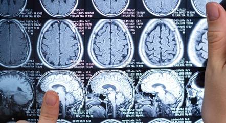 tomografia-cerebro-08082023131922708