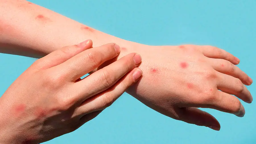 mpox-26329.jpg